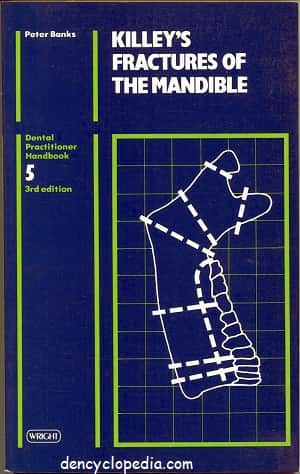 Killy’s Fractures of the Mandible – Dencyclopedia